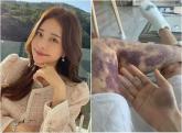 아옳이, 피부과 시술 후 전신 피멍 '13억 소송' 이겼다... '허위사실 적시 아냐'